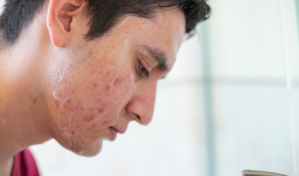 How Long Does It Take to See Results from Accutane?