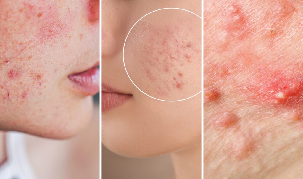 Accutane Birth Defects: What You Need to Know