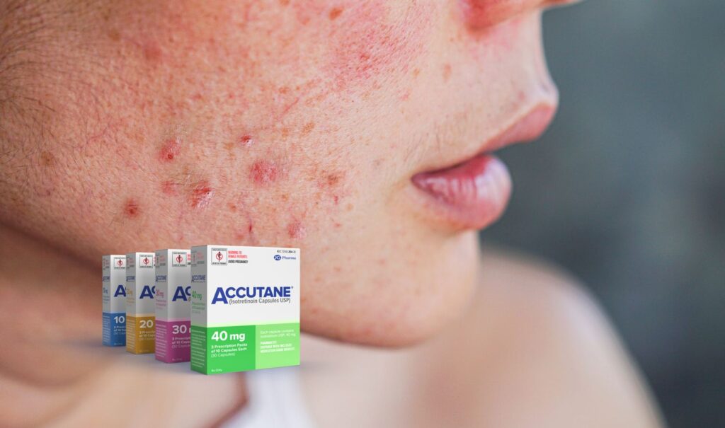 FAQs About Accutane: Common Questions Answered