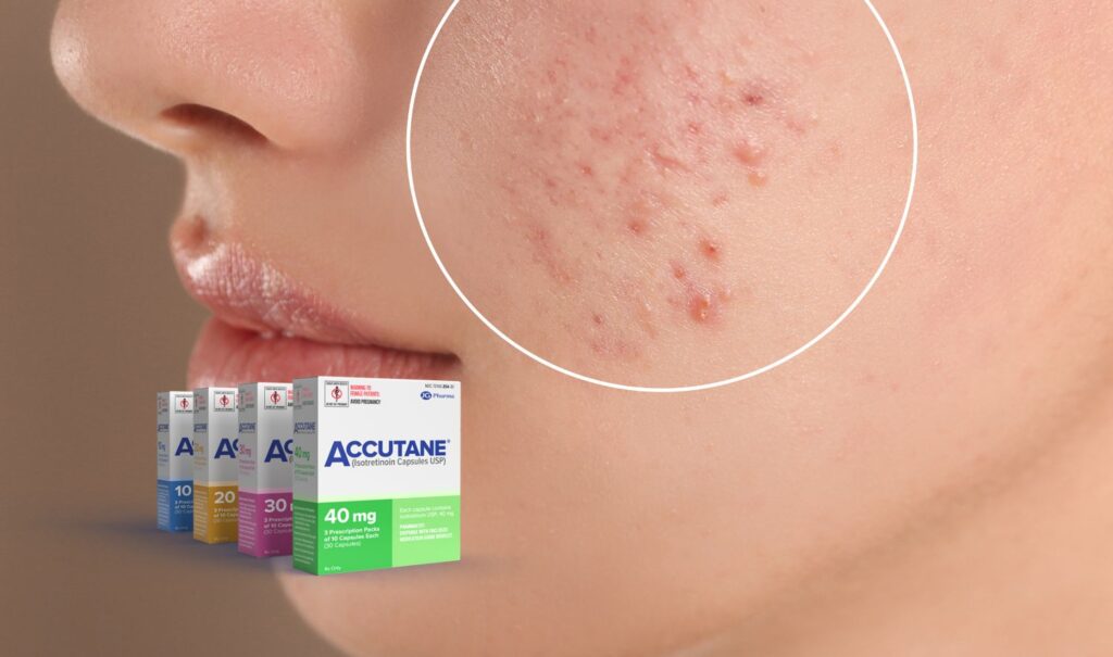 Accutane and the Skin: Understanding Its Effects