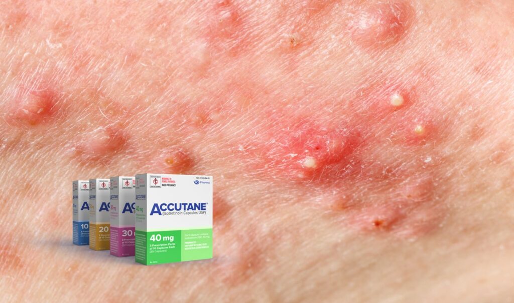 Accutane Dosage: Finding the Right Amount for You