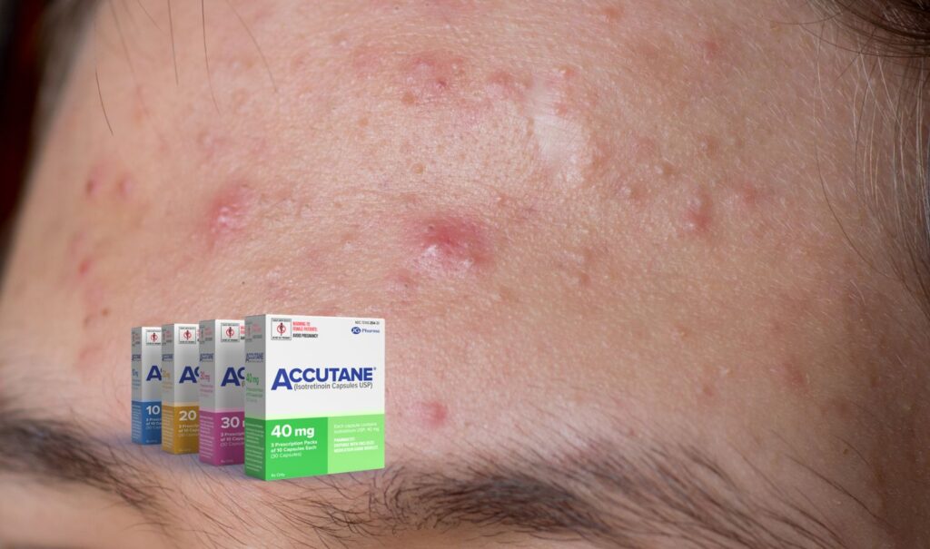 Managing Common Side Effects of Accutane